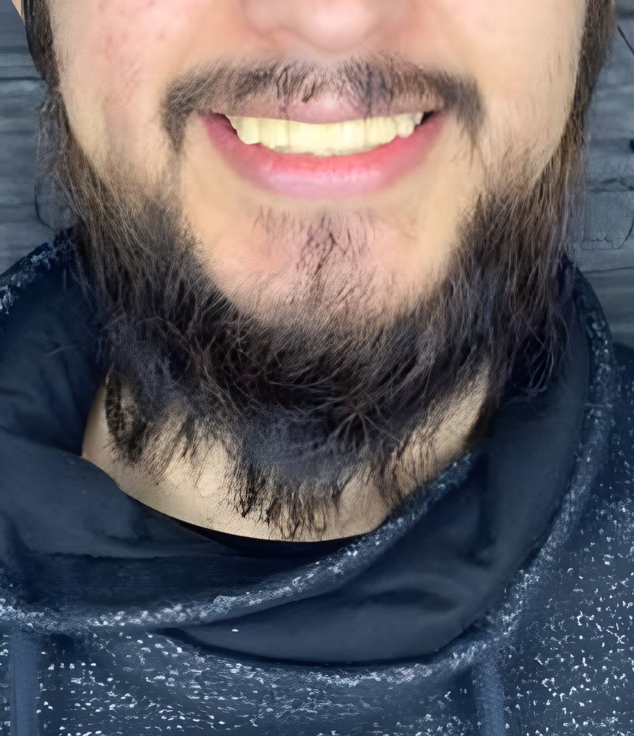 Sonrisa antes del blanqueamiento dental