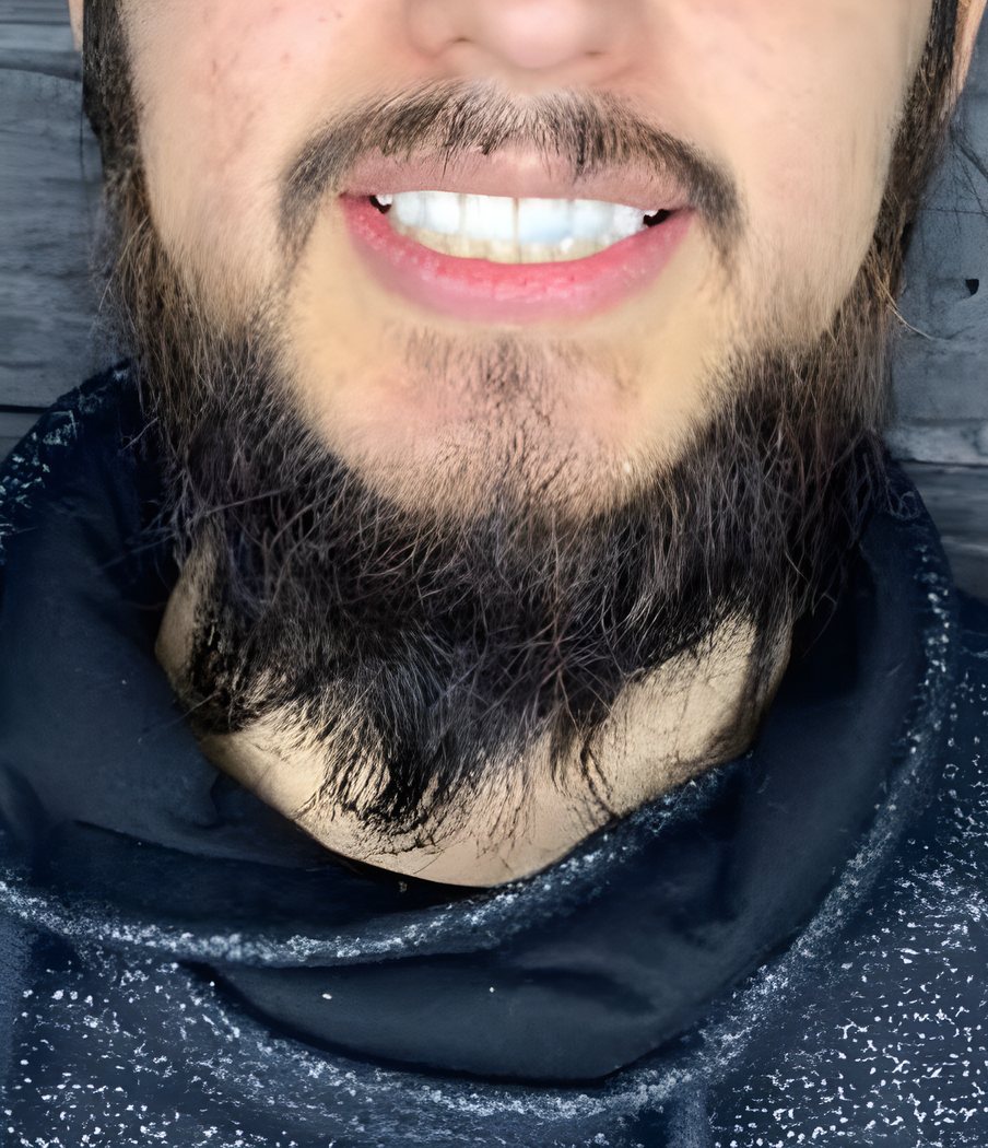 Sonrisa después del blanqueamiento dental