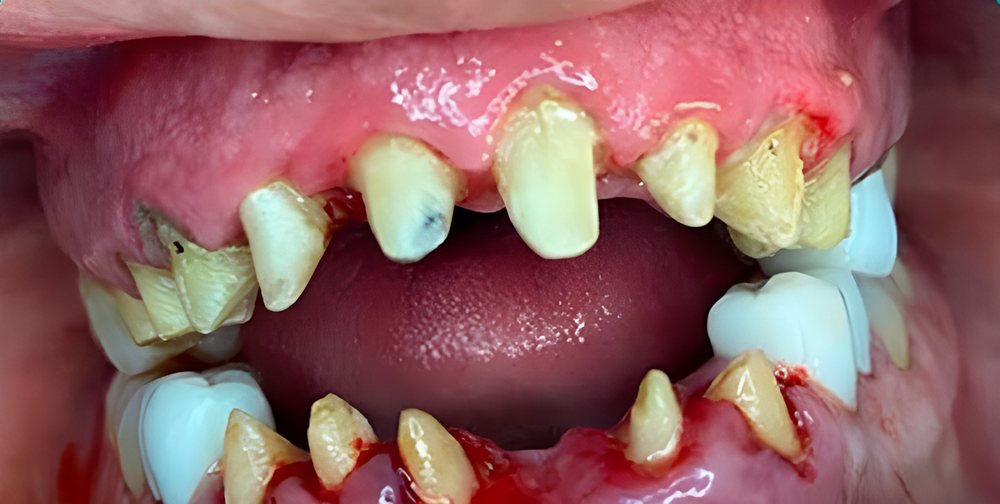 Dientes desgastados antes de las carillas