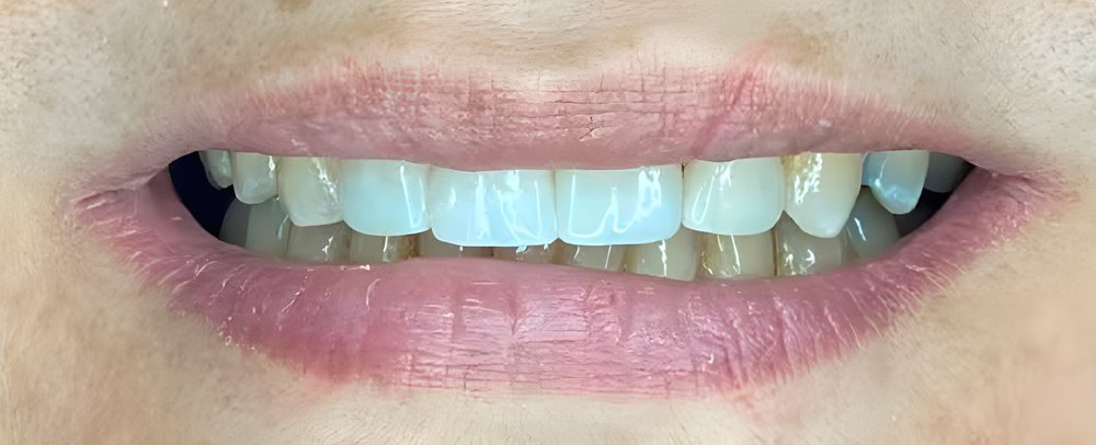 Sonrisa con coronas de zirconia