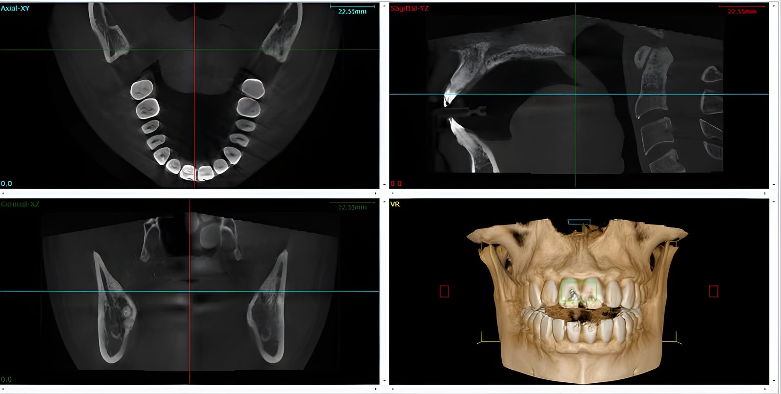 Tomografía Cone Beam de un paciente con vistas en corte y reconstrucción 3D de dientes y mandíbula